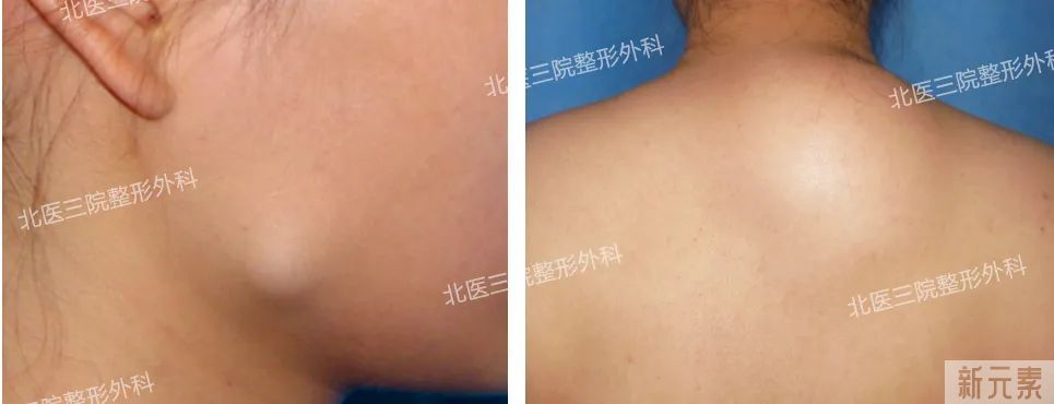 脂肪瘤必须要手术切掉吗? 图片-1