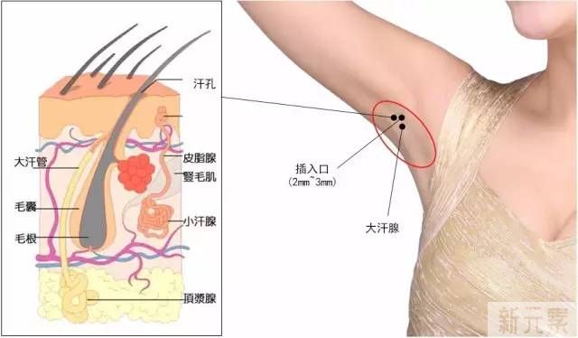 为什么很多人闻不到自己有腋臭? 图片-10