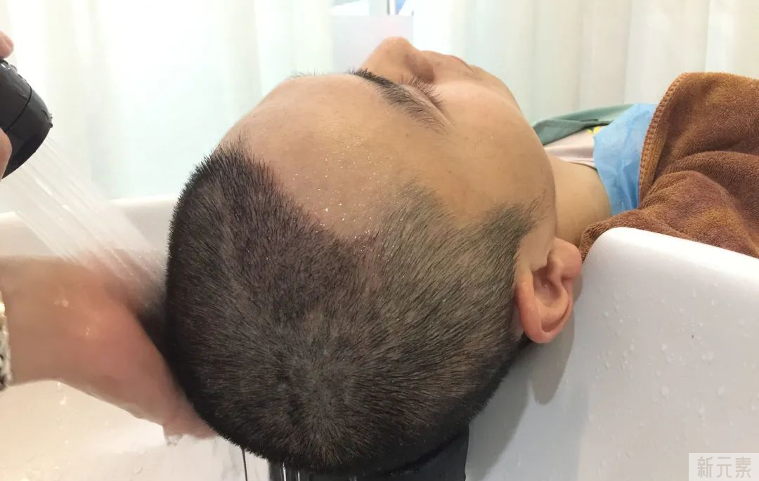 植发失败我已经会判断了，植发成功如何判断? 图片-1