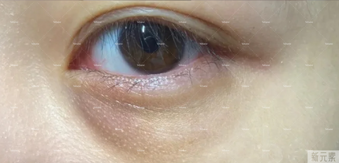 痔疮膏祛眼袋是什么鬼?祛眼袋的3个雷区和4个正确方法，现在讲清楚! 图片-3