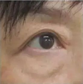 痔疮膏祛眼袋是什么鬼?祛眼袋的3个雷区和4个正确方法，现在讲清楚! 图片-8