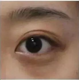 痔疮膏祛眼袋是什么鬼?祛眼袋的3个雷区和4个正确方法，现在讲清楚! 图片-5
