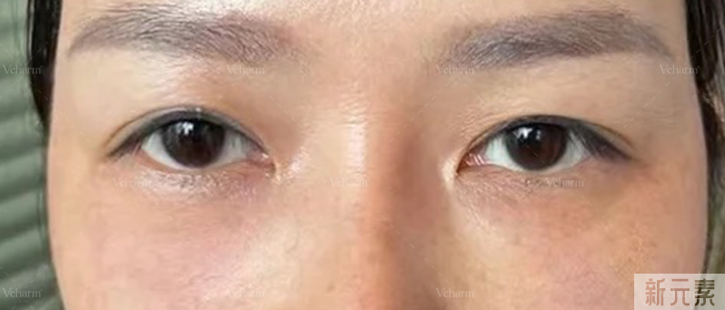 痔疮膏祛眼袋是什么鬼?祛眼袋的3个雷区和4个正确方法，现在讲清楚! 图片-16