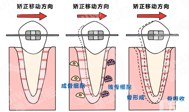 正畸攻略 | 牙齿矫正越快越好吗?能不能随意加速呢? 图片-3