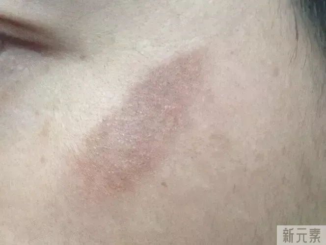 色素疤痕是怎么样形成的?如何快速祛除? 图片-4