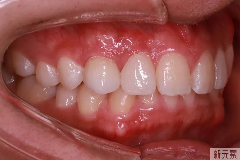 门牙缺了一小块怎么办? 图片-10