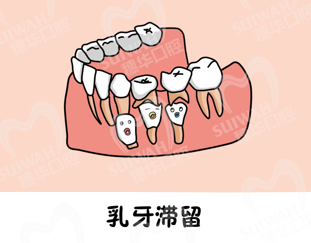 牙齿不齐烦恼多!!那么造成牙齿不齐的原因你都知道吗?? 图片-4