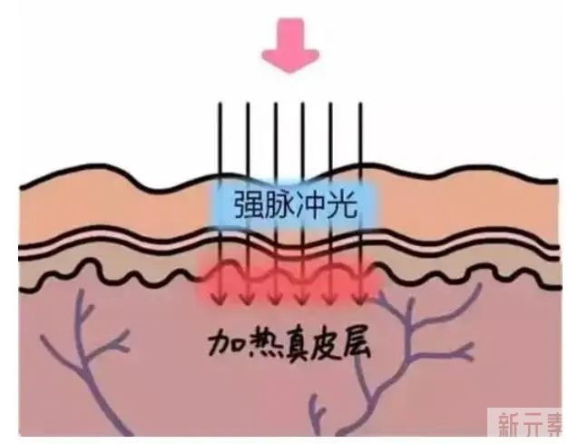 光子嫩肤操作时间短，是不是亏了? 图片-1