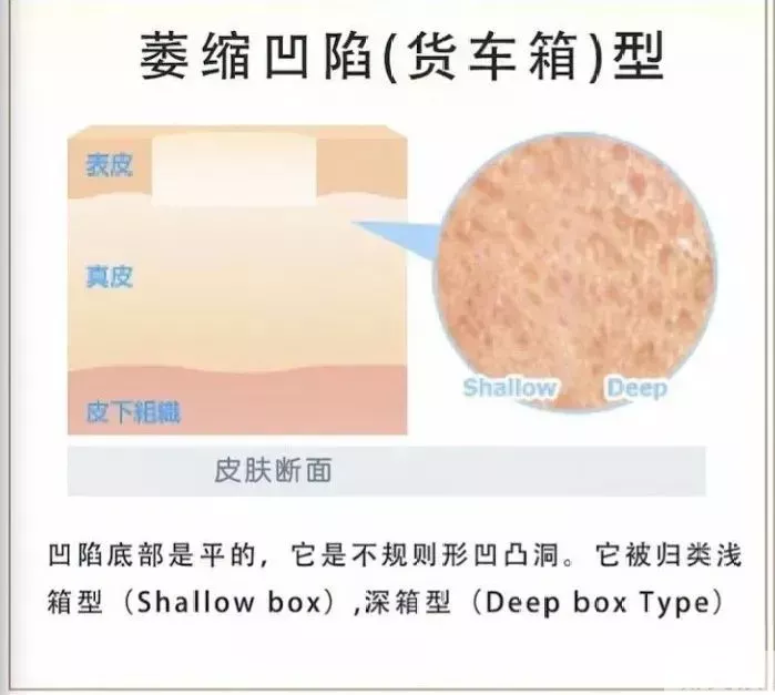 关于痘坑，教你如何&quot摆平&quot它! 图片-9